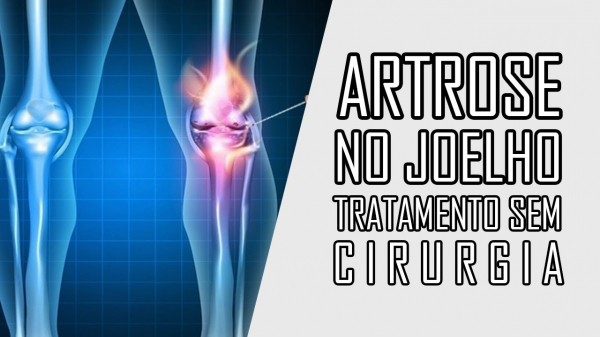 Tratamento da artrose do joelho sem cirurgia Stella Winnikes Bem Paraná