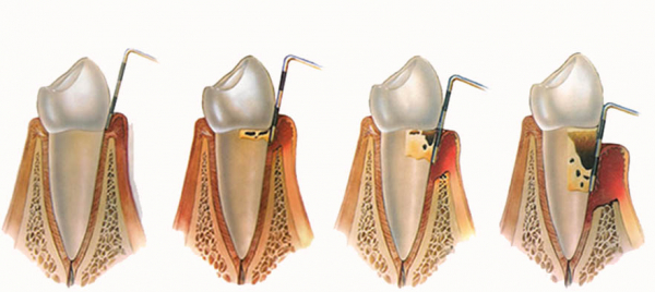 Dentes saudável e com osteoporose inicial, moderada e avançada