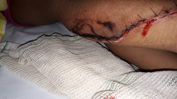 Corte na perna de criança de três anos