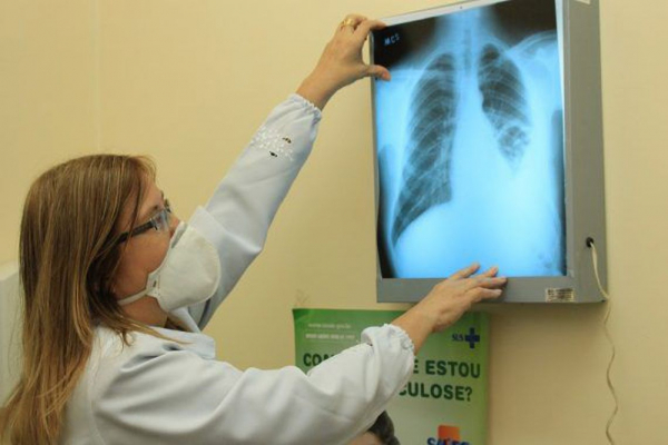 Exame de raio-x de pulmÃ£o: para detectar traÃ§o de tuberculose