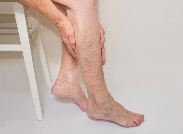 tinctura de castan de reeta varicoasa caracterul durerii în picioare în varicoza